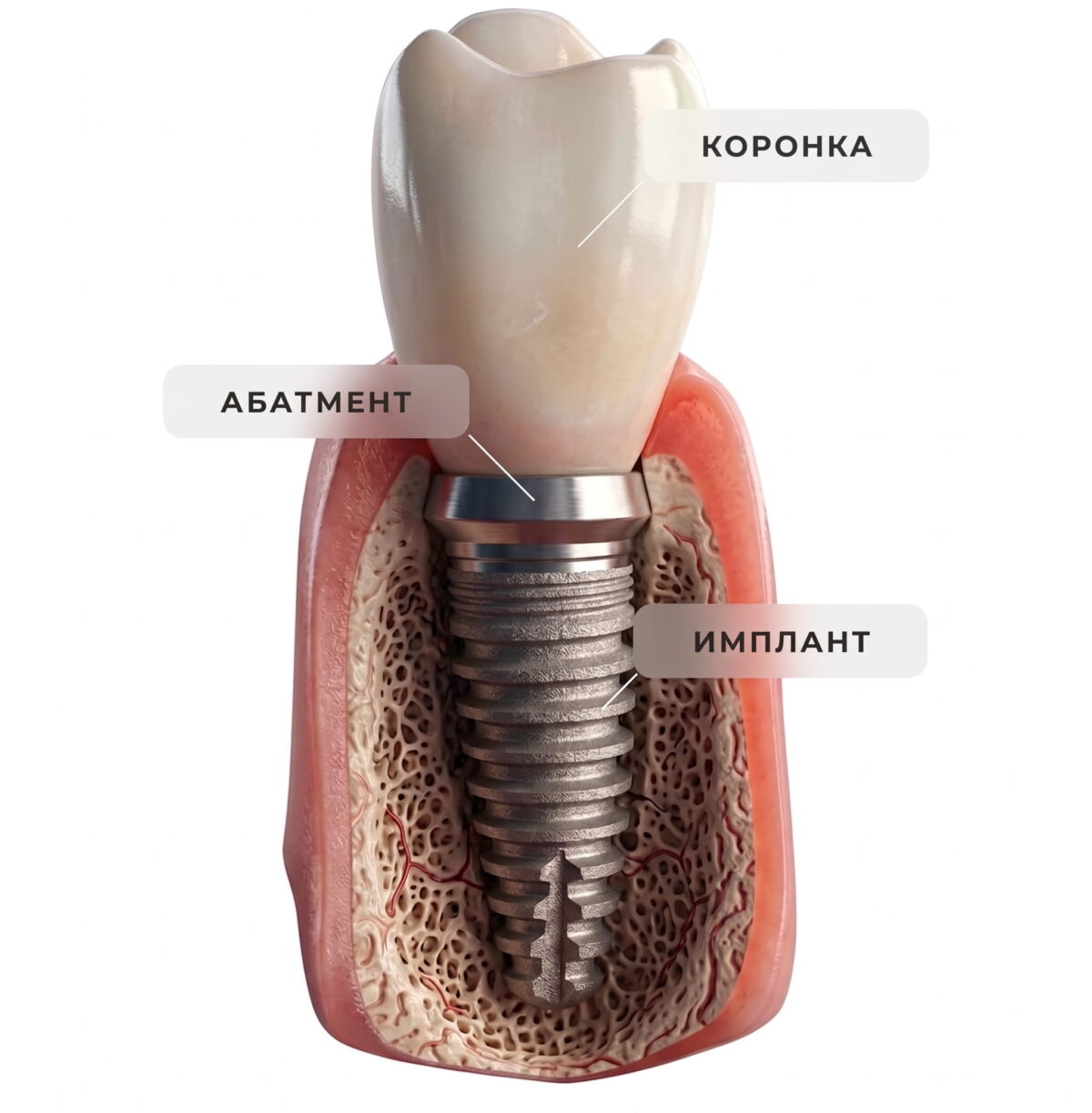 dental implants turkey