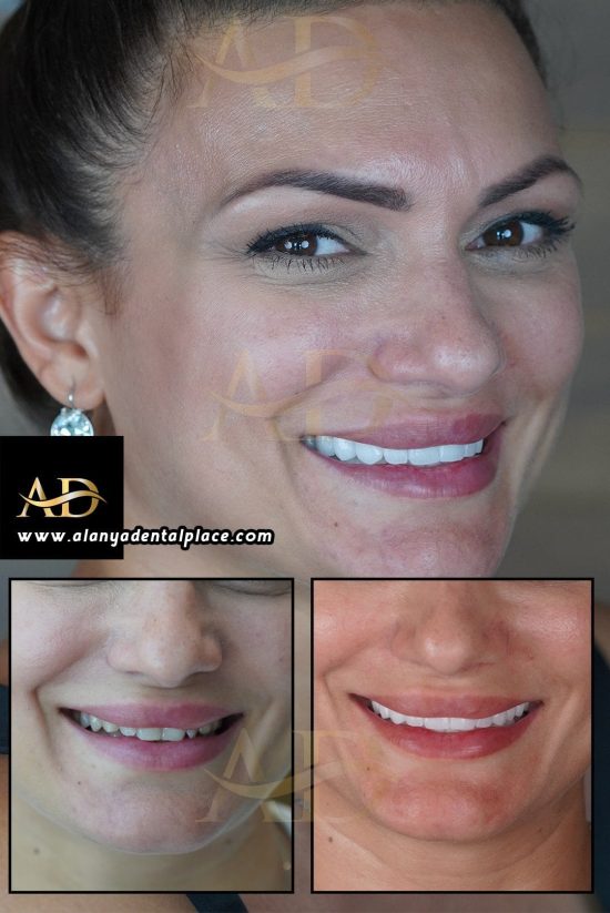 Dental Implants Before / After