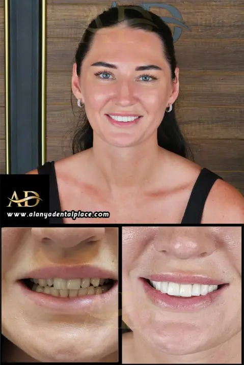 Dental Implants Before / After