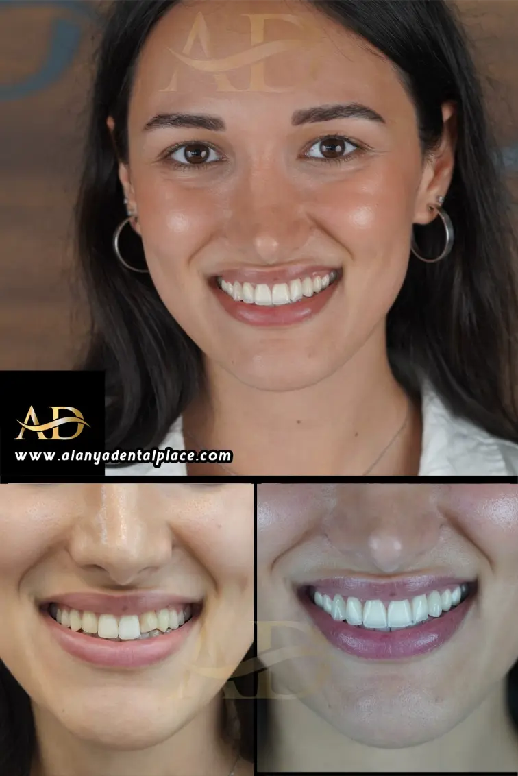 Dental Implants Before / After