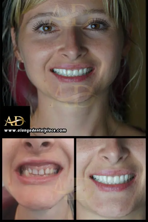 Dental Implants Before / After