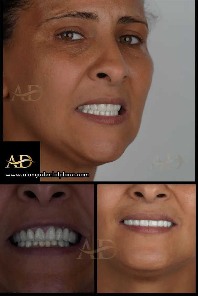 Dental Implants Before / After