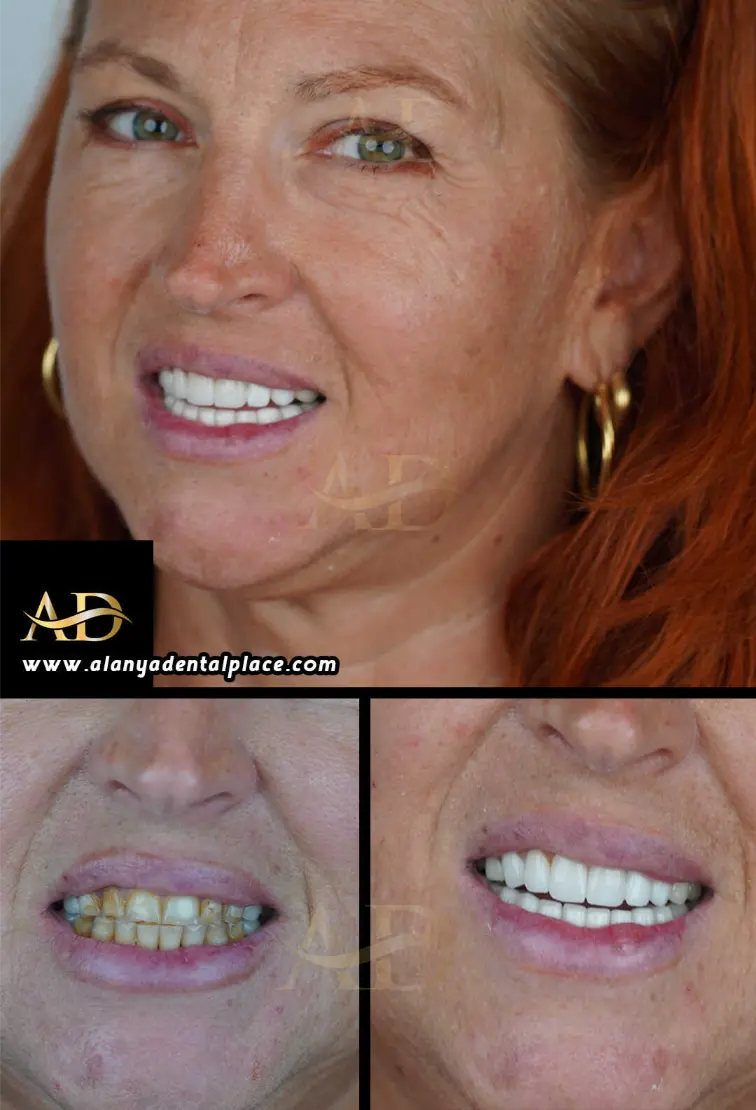 Dental Implants Before / After
