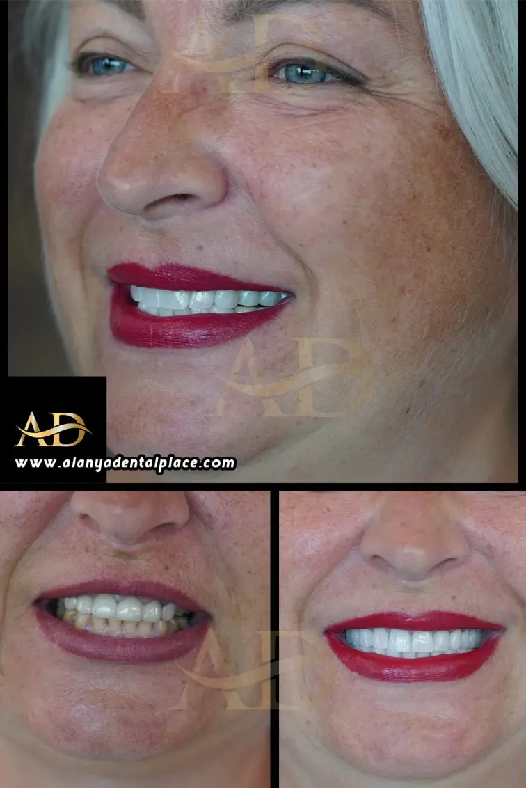 Dental Implants Before / After