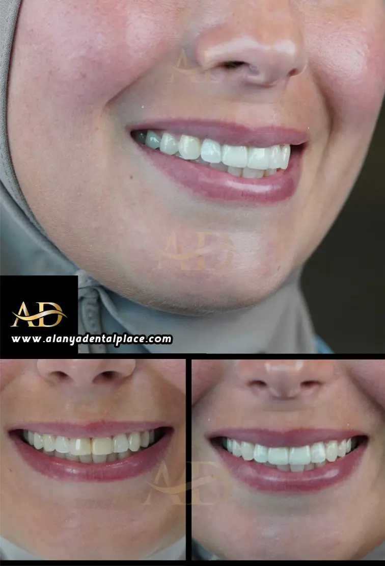 Dental Implants Before / After