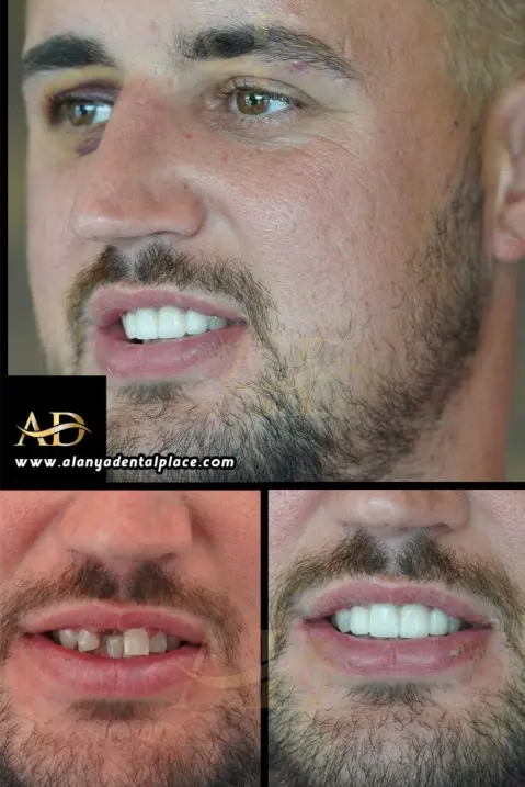 Dental Implants Before / After