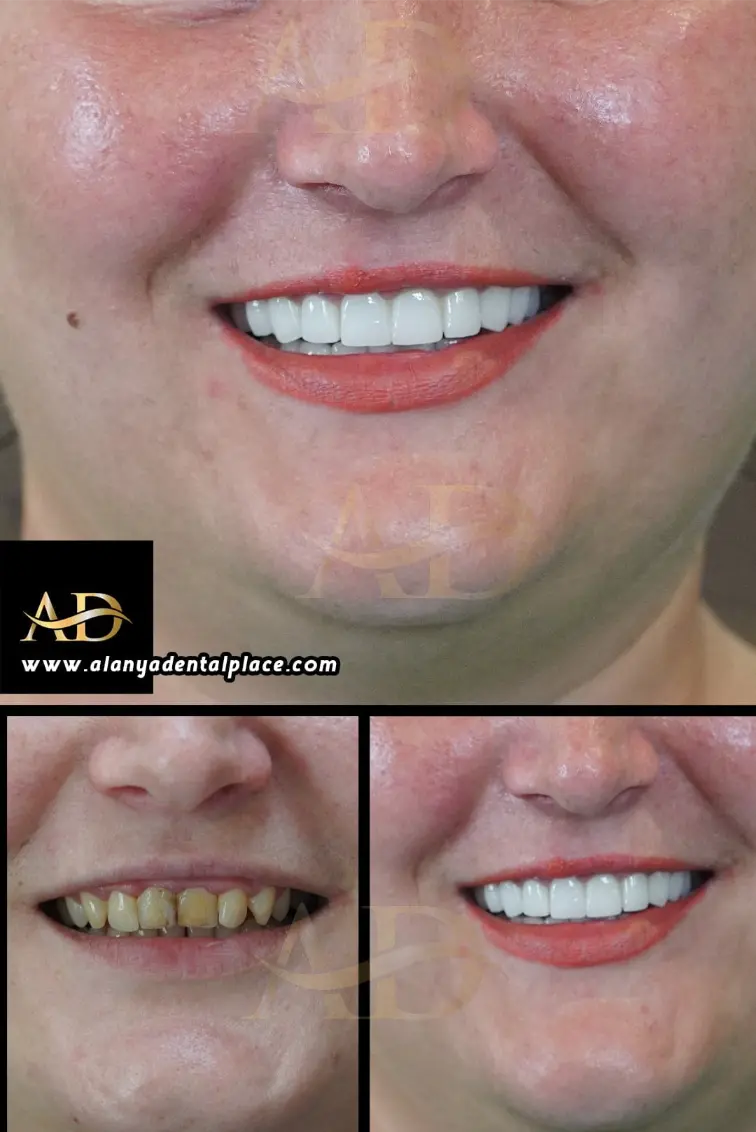 Dental Implants Before / After