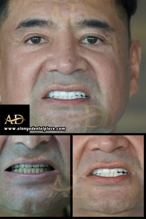 Dental Implants Before / After