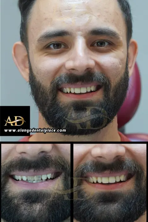Dental Implants Before / After
