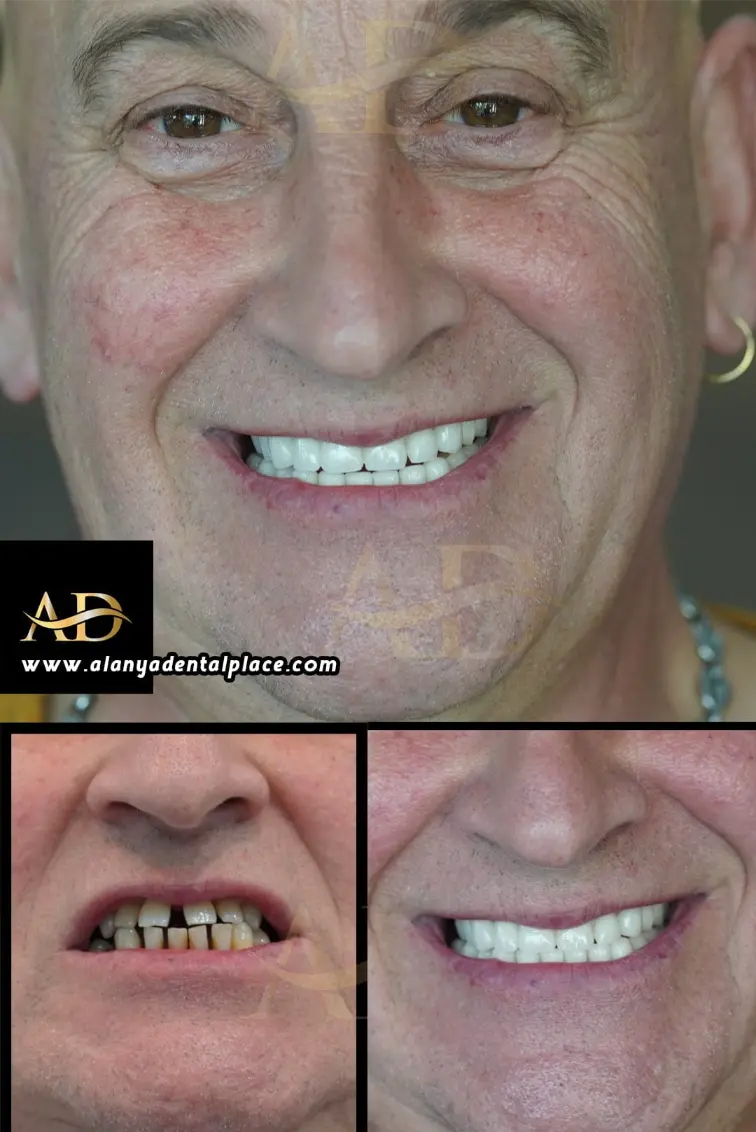 Dental Implants Before / After