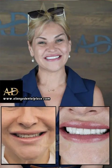 Dental Implants Before / After