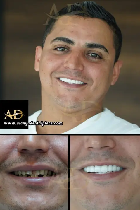 Dental Implants Before / After