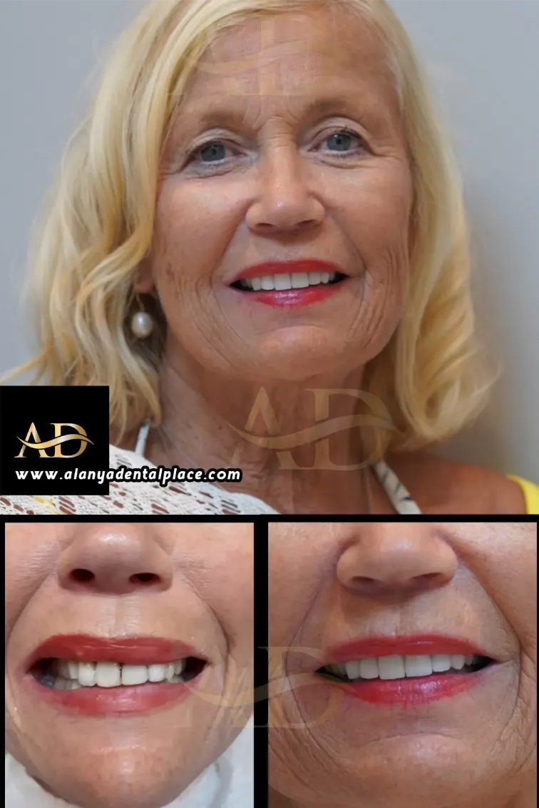 Dental Implants Before / After