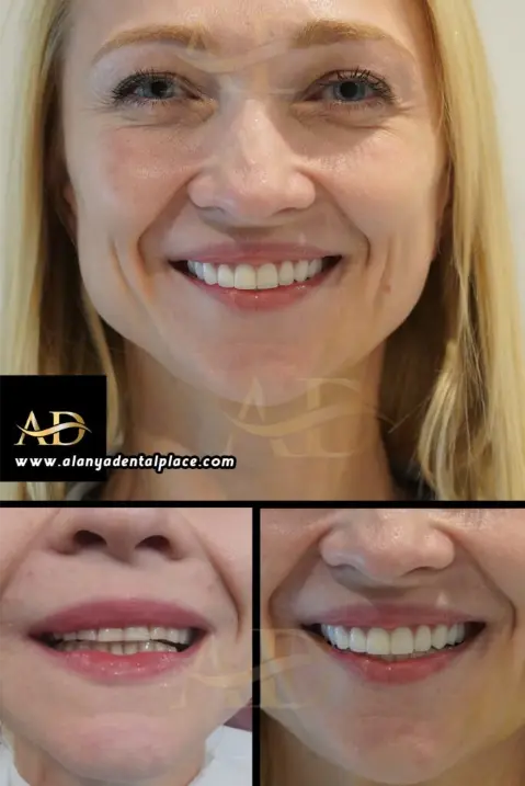 Dental Implants Before / After