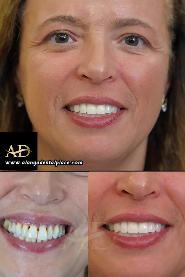 Dental Implants Before / After