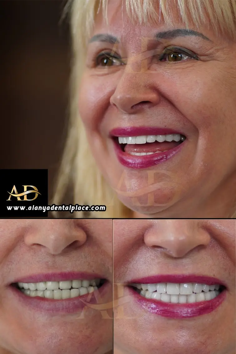 Dental Implants Before / After