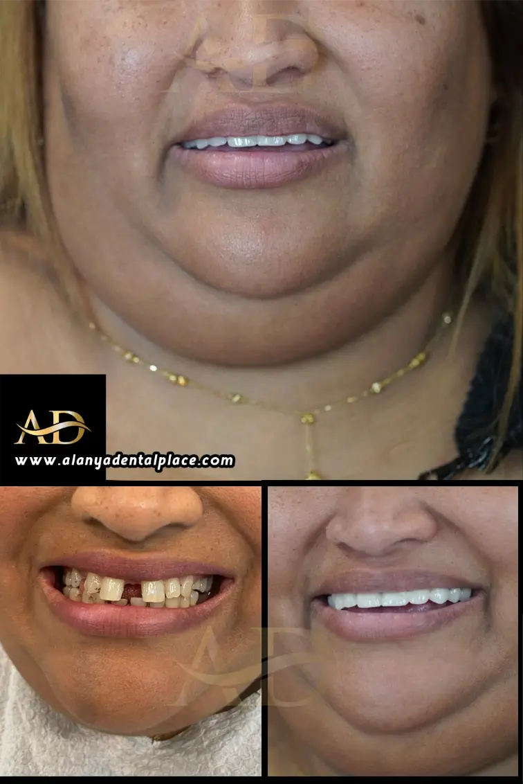 Dental Implants Before / After