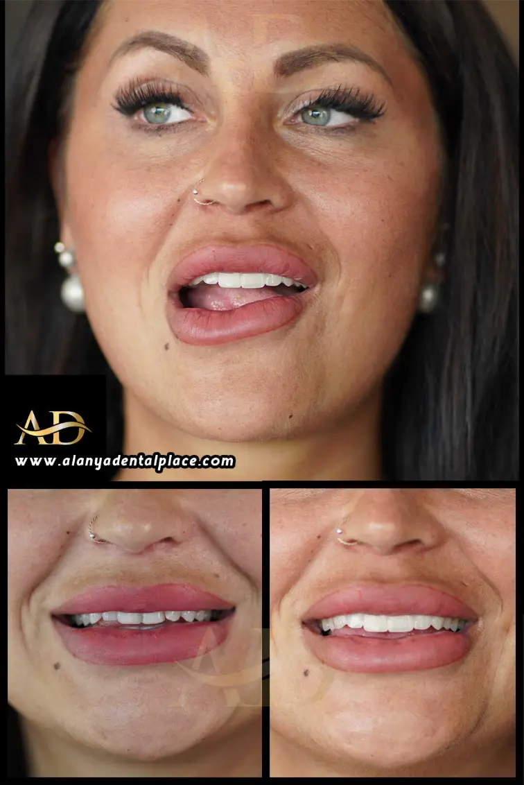 Dental Implants Before / After