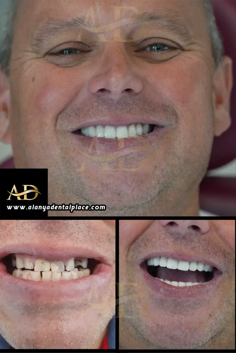 Dental Implants Before / After