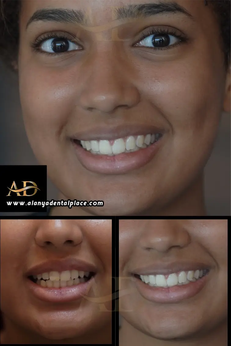 Dental Implants Before / After