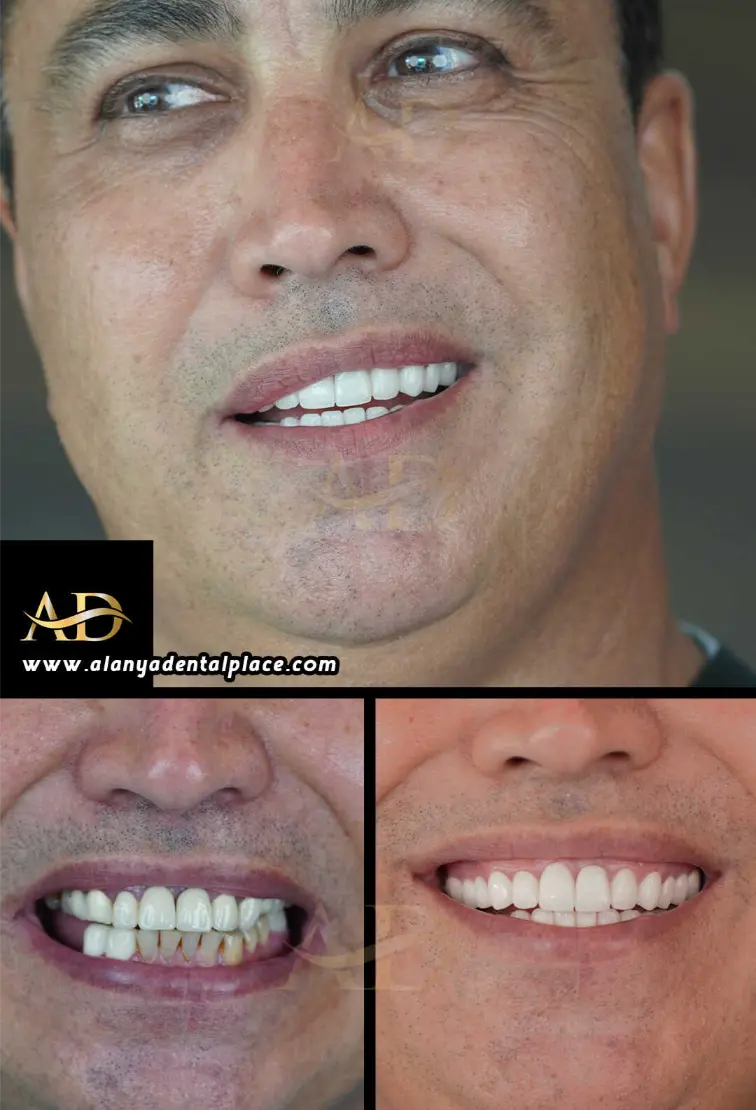 Dental Implants Before / After