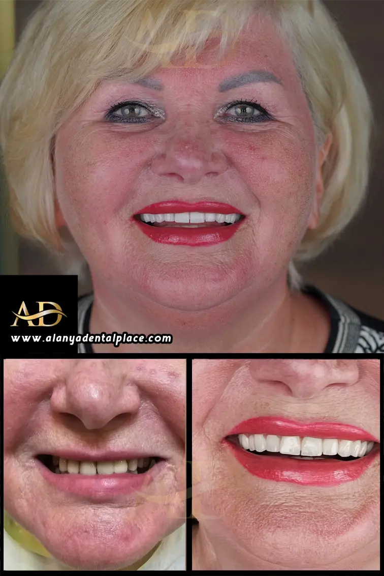 Dental Implants Before / After