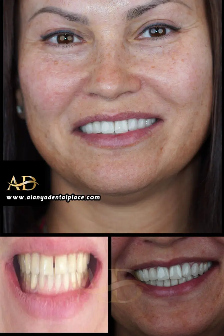 Dental Implants Before / After