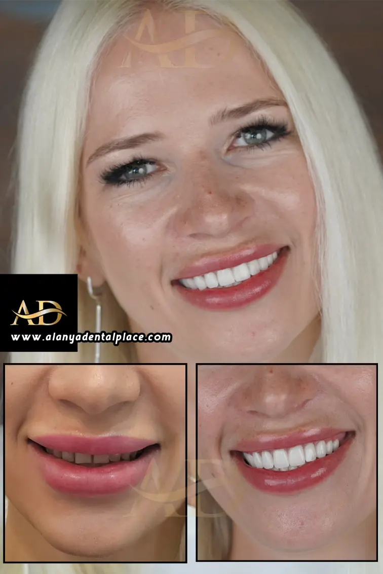 Dental Implants Before / After