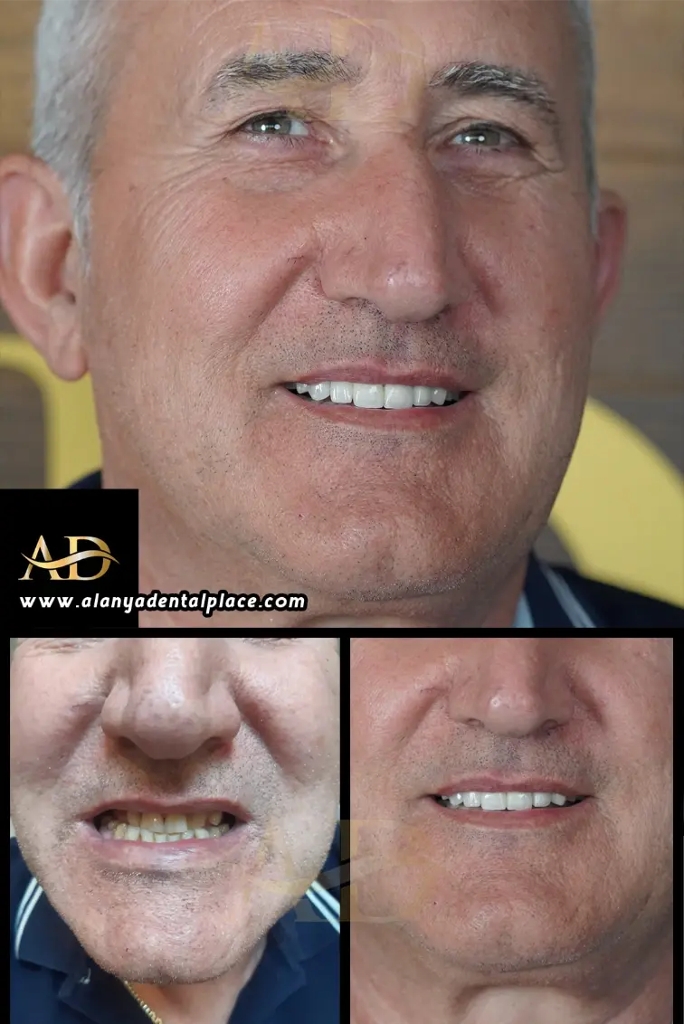 Dental Implants Before / After