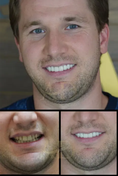Dental Implants Before / After