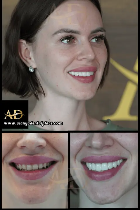 Dental Implants Before / After