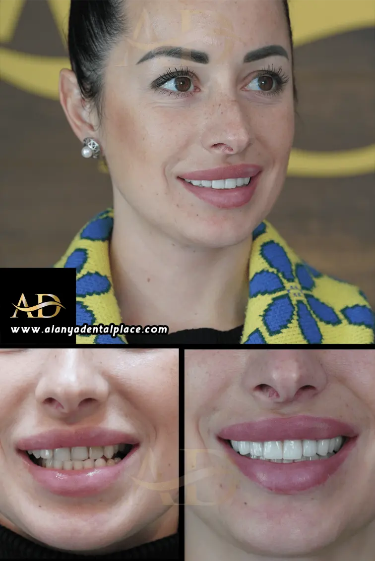 Dental Implants Before / After