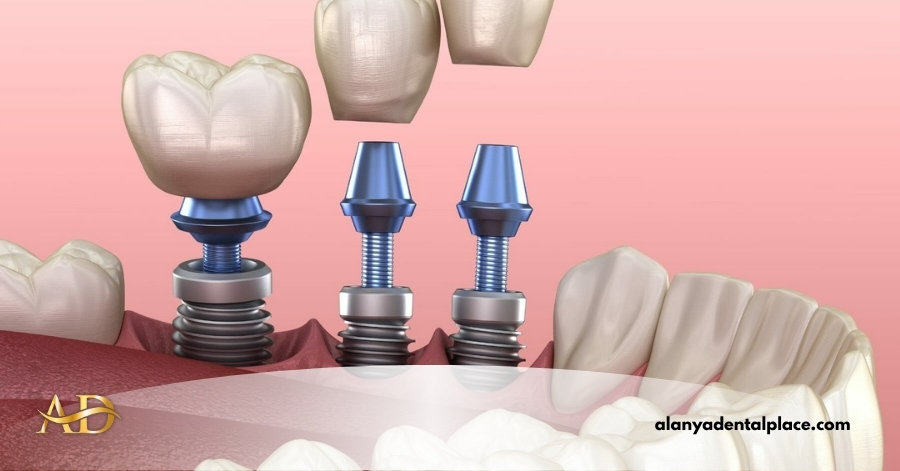 diş implantı