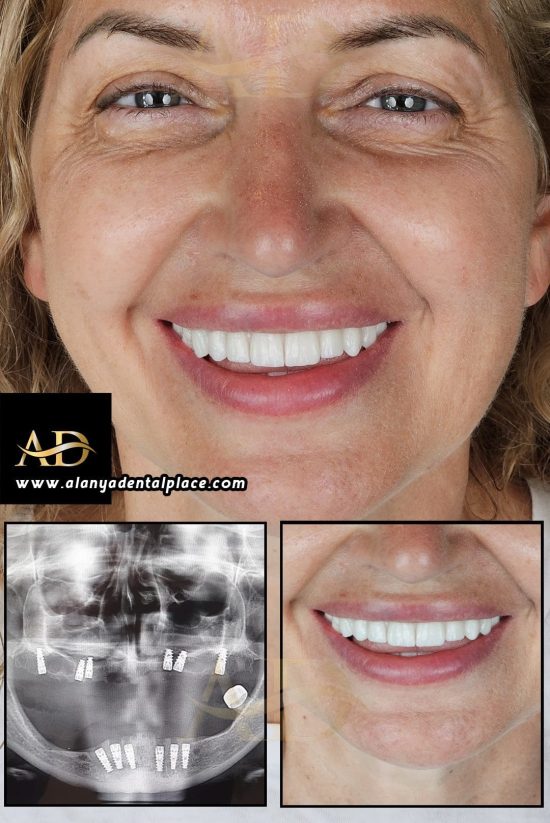 Dental Implants Before / After