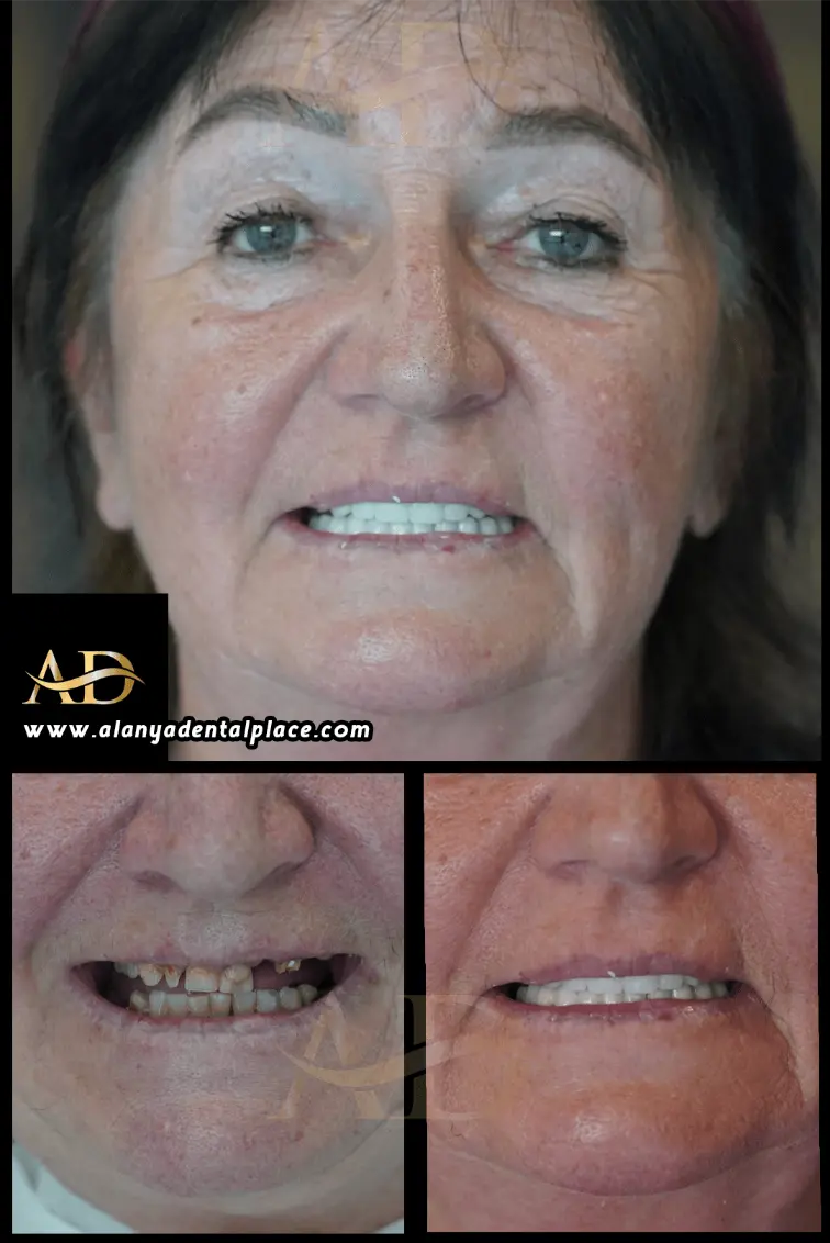Dental Implants Before / After
