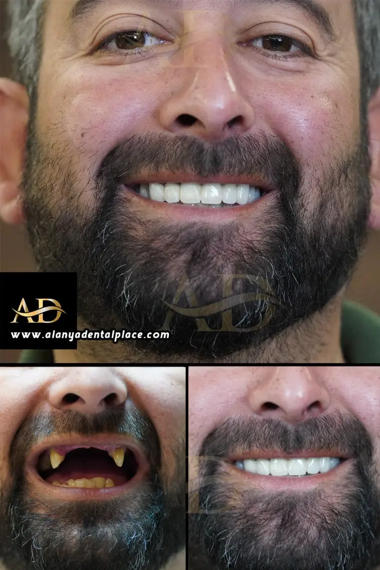 Dental Implants Before / After
