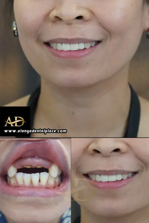 Dental Implants Before / After