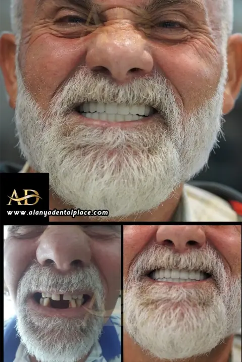 Dental Implants Before / After