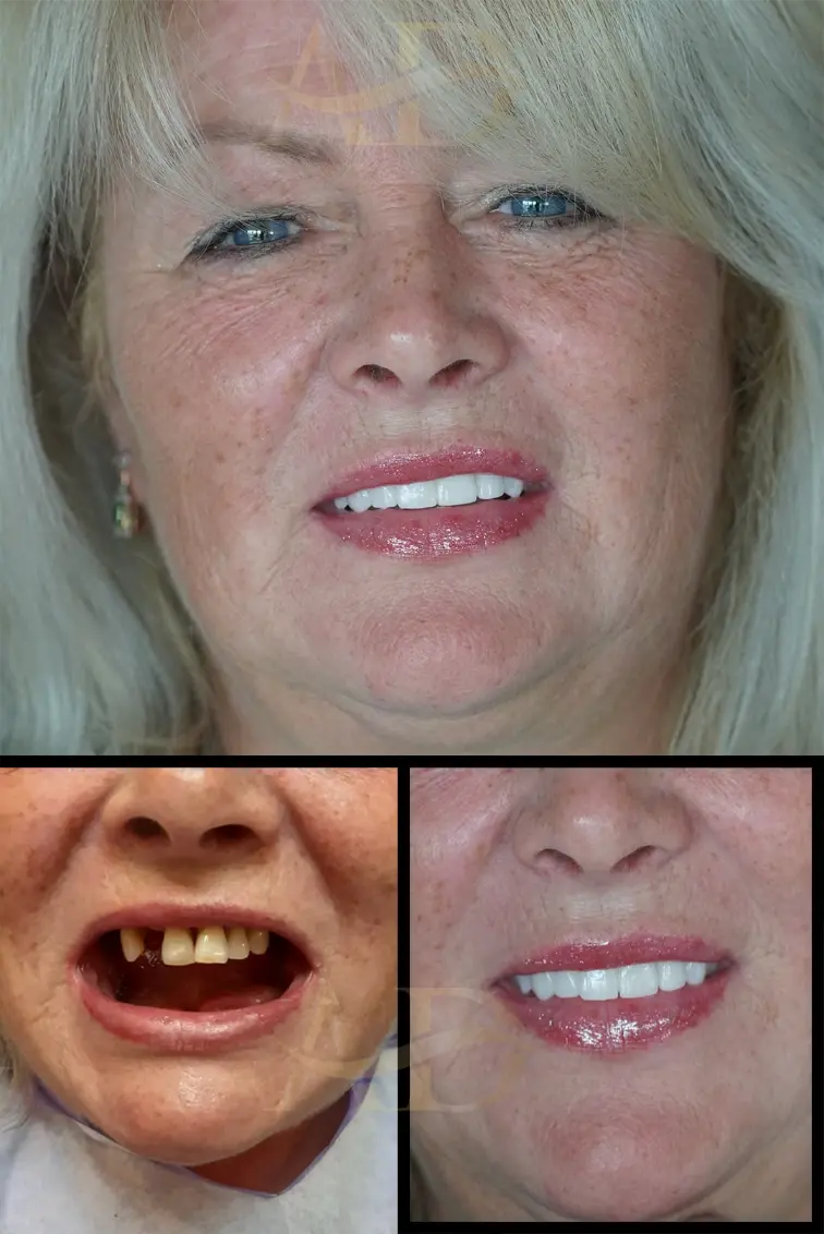 Dental Implants Before / After