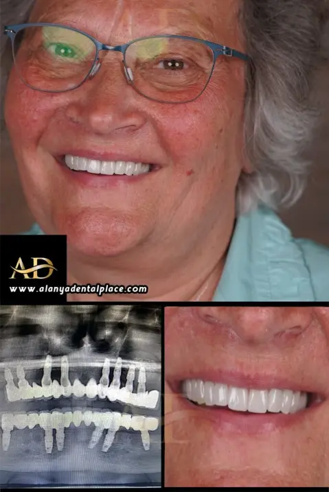 Dental Implants Before / After