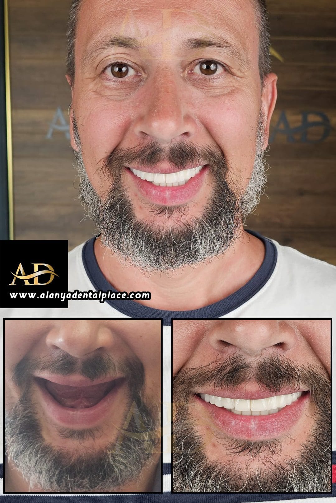 Dental Implants Before / After