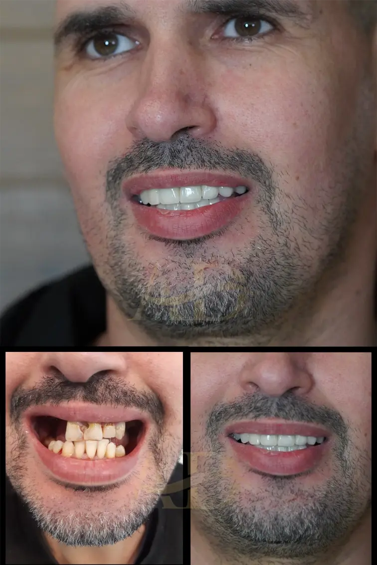 Dental Implants Before / After
