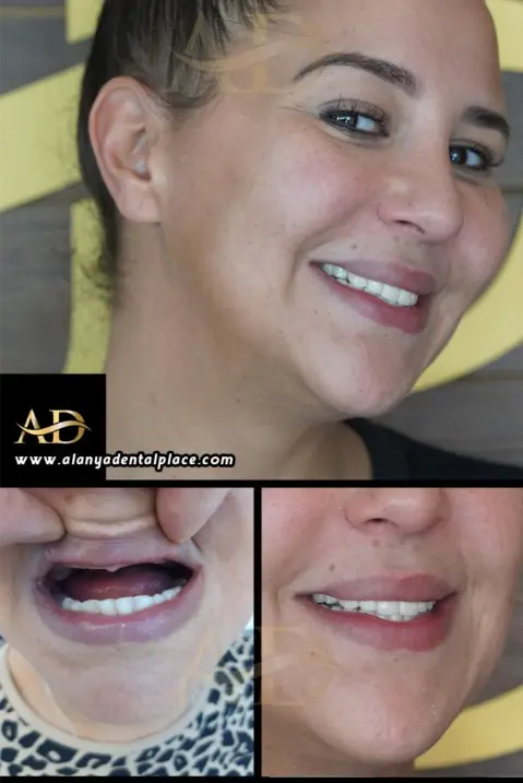 Dental Implants Before / After