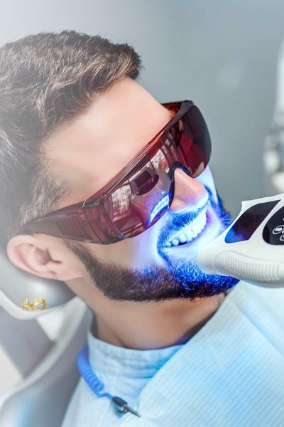 Teeth Whitening (Bleaching)